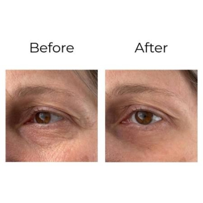 Peptilux - kortsuvastane 'shock action effect' silmaümbruskreem LIPHASYN™-iga