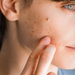 Ichthammoli salv 9.8% - 3